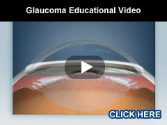 Glaucoma Educational Video