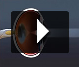 Cataract Educational Video